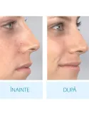 Aspirator facial Derma Suction