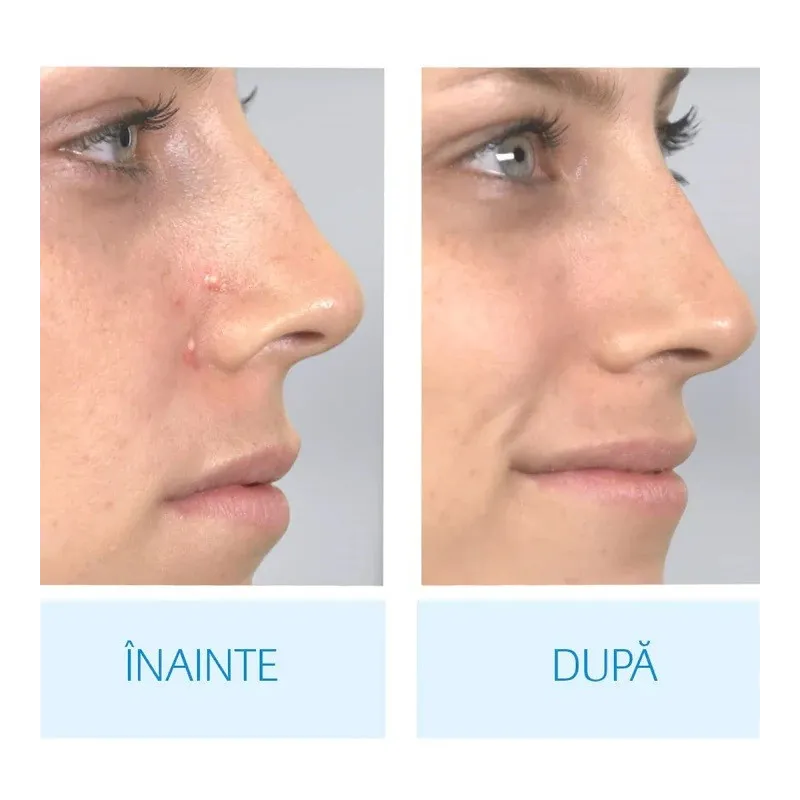 Aspirator facial Derma Suction