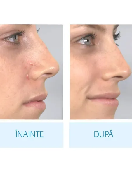 Aspirator facial Derma Suction